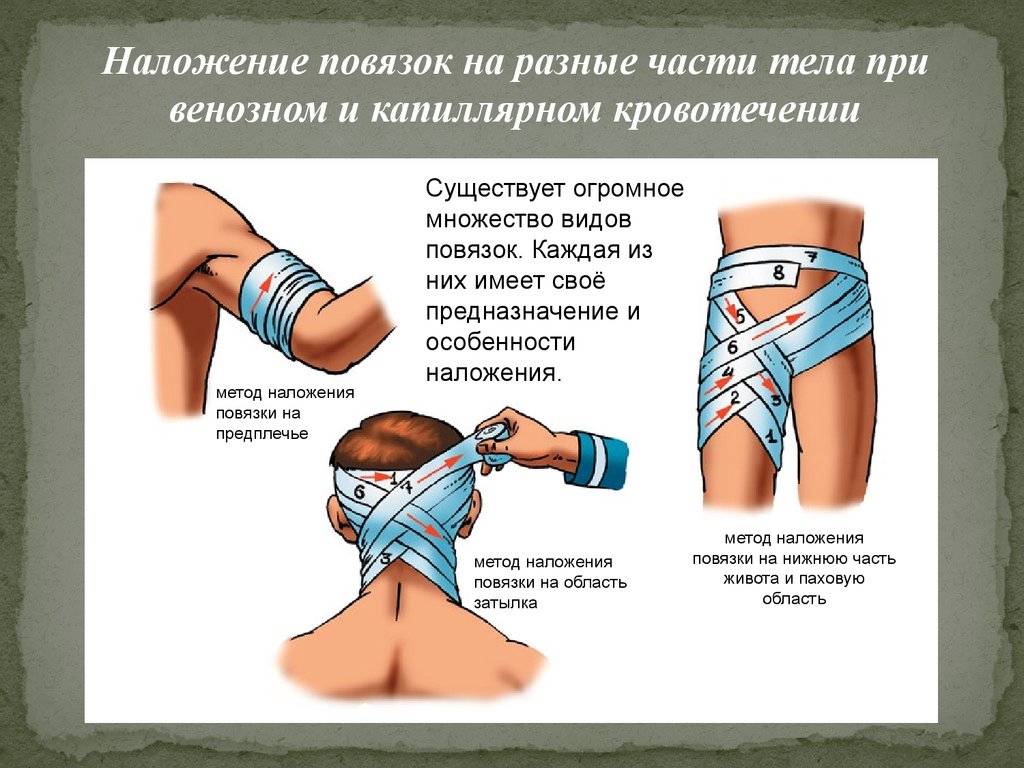 При венозном кровотечении какую наложить повязку. Наложение повязок на различные части тела. Повязки и техника их наложения. Повязка при кровотечении.