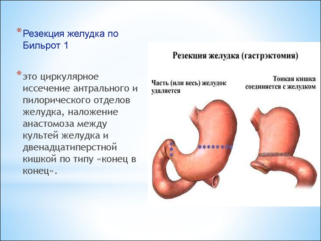 1 3 желудка. Операции на желудке Бильрот 1 и 2. Резекция желудка Бильрот 1. Антральной резекции желудка.