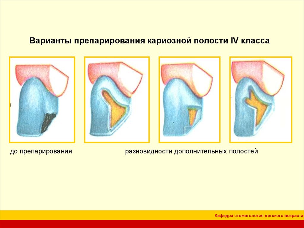 Классификация кариозных полостей по блэку презентация