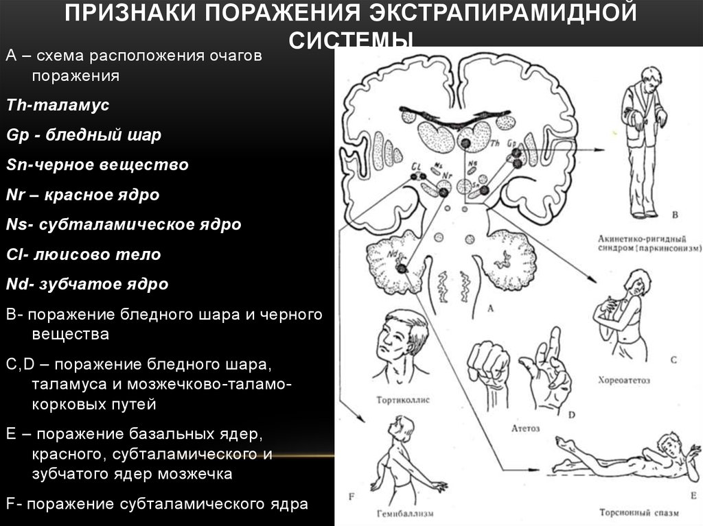 Признаки поражения. Экстрапирамидная система неврология нарушения. Экстрапирамидная система и синдромы ее поражения неврология. Симптомы поражения пирамидной и экстрапирамидной системы. Симптомы поражения структур экстрапирамидной системы.