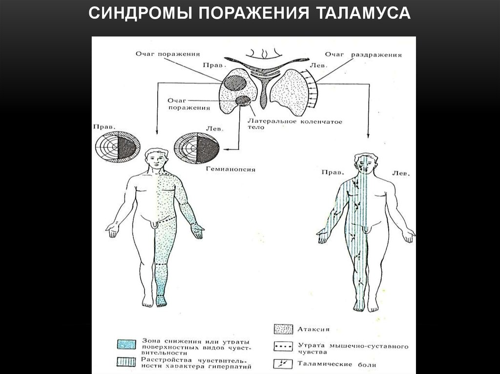 Поражение правого. Зрительный бугор симптомы поражения неврология. Симптомы поражения таламуса неврология. Синдром поражения таламуса. Синдромы поражения промежуточного мозга.