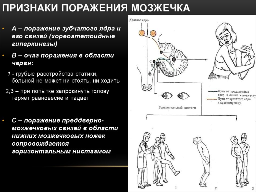 Двигательные симптомы поражения