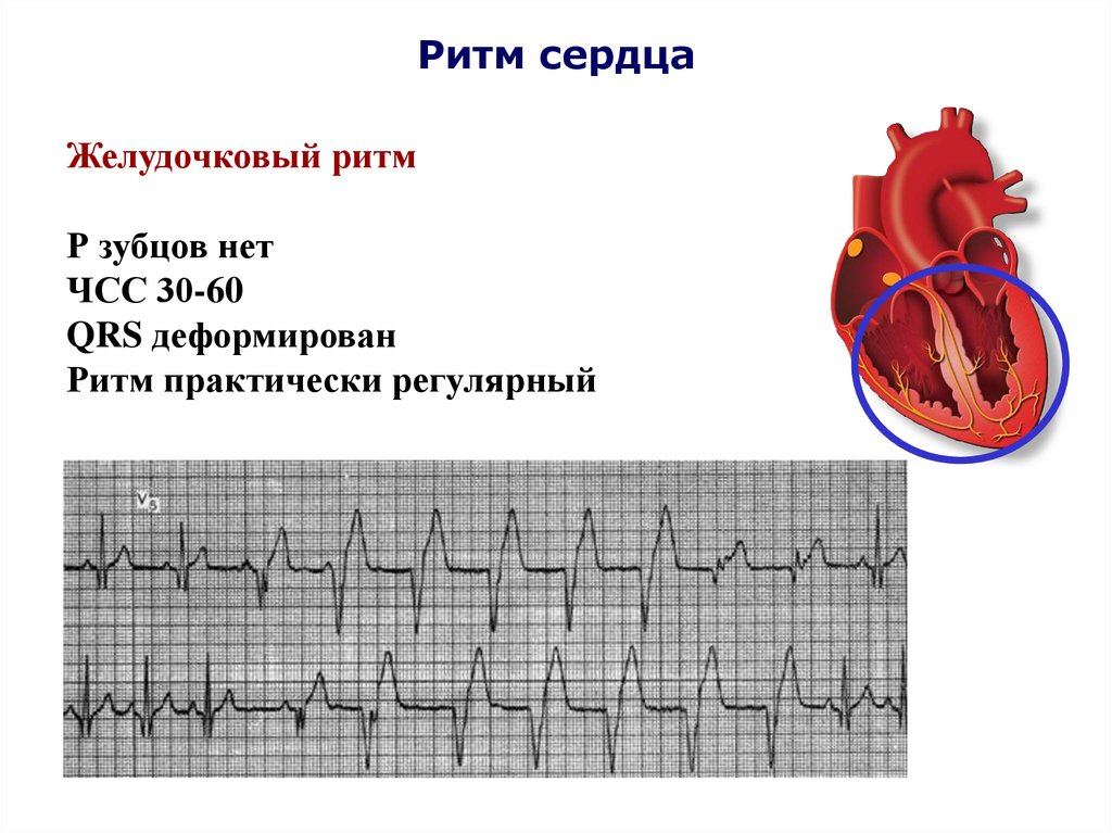 Желудочковый ритм. Желудочковый ритм на ЭКГ. Ускоренный желудочковый ритм на ЭКГ. Идиовентрикулярный желудочковый ритм на ЭКГ. Желудочковый ритм на ЭКГ признаки.