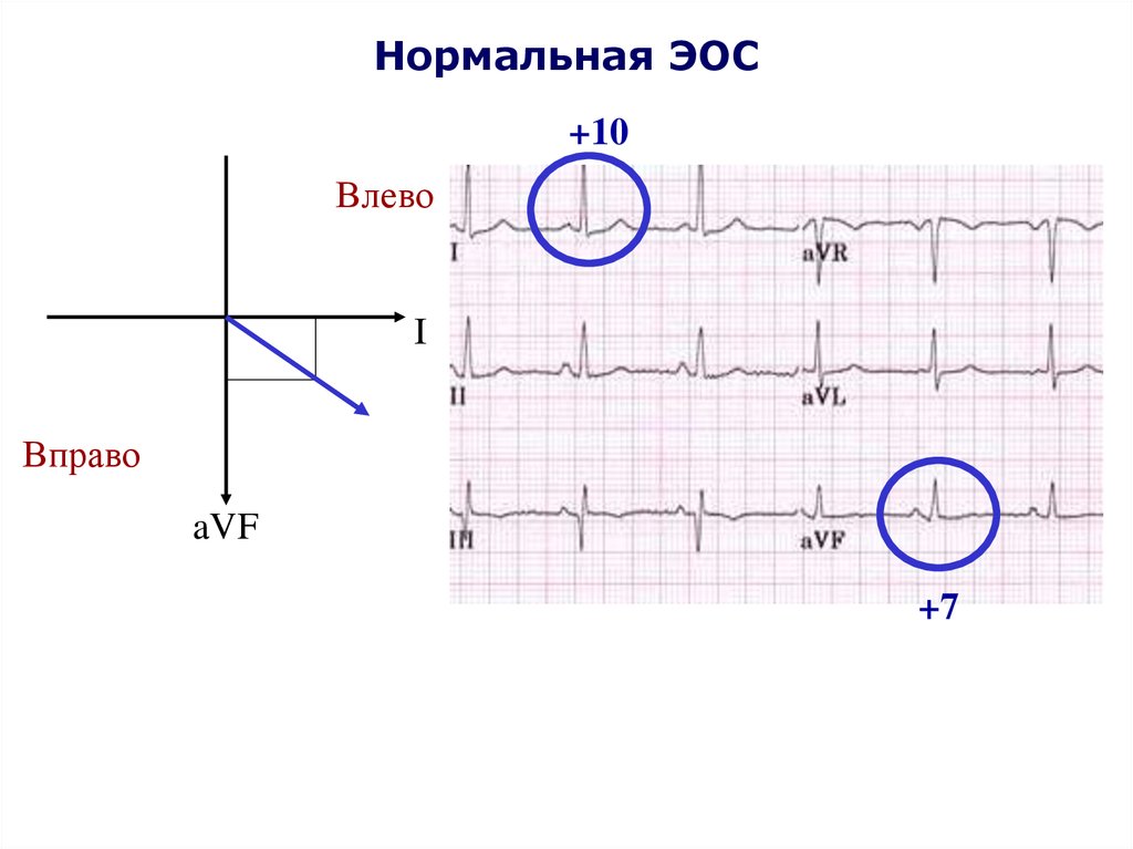Сердце отклонено вправо. Отклонение ЭОС влево на ЭКГ. Нормальная ЭОС. ЭОС влево вправо. Нормальная электрическая ось.