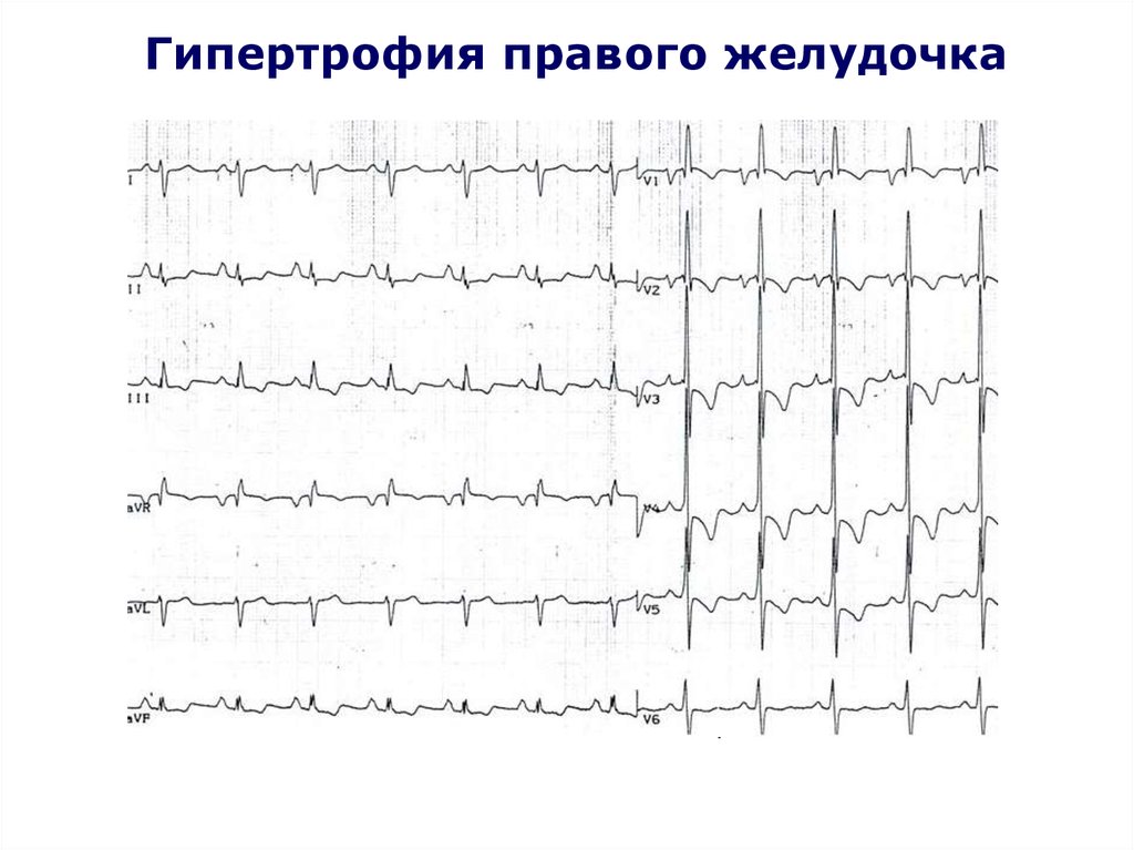 Экг гипертрофия правого. Гипертрофия правого желудочка на ЭКГ. Электрокардиографические признаки гипертрофии правого желудочка. Признаки гипертрофии правого желудочка на ЭКГ. ЭКГ гипертрофия правого желудочка ЭКГ.