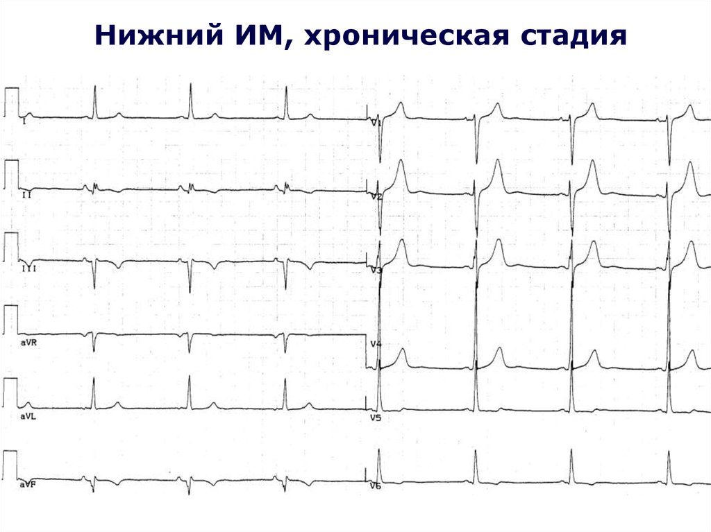 Схема электрической активности сердца является материальной моделью информационной моделью