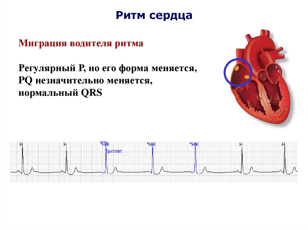 Водитель сердца. Миграция предсердного водителя ритма. ЭКГ при миграции водителя ритма. Миграция суправентрикулярного водителя ритма на ЭКГ. ЭКГ при миграции водителя ритма по предсердиям.