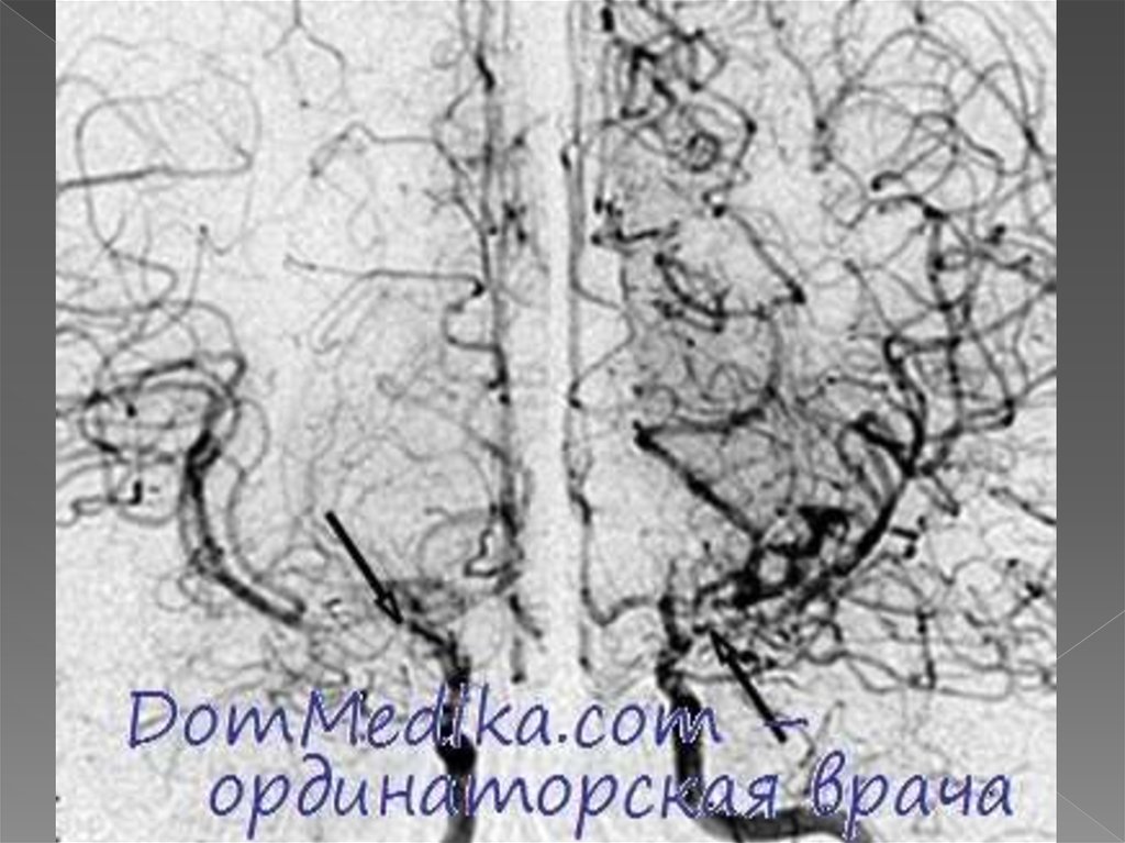 Болезнь моя моя. Болезнь моя моя ангиография. Моя моя болезнь симптомы.