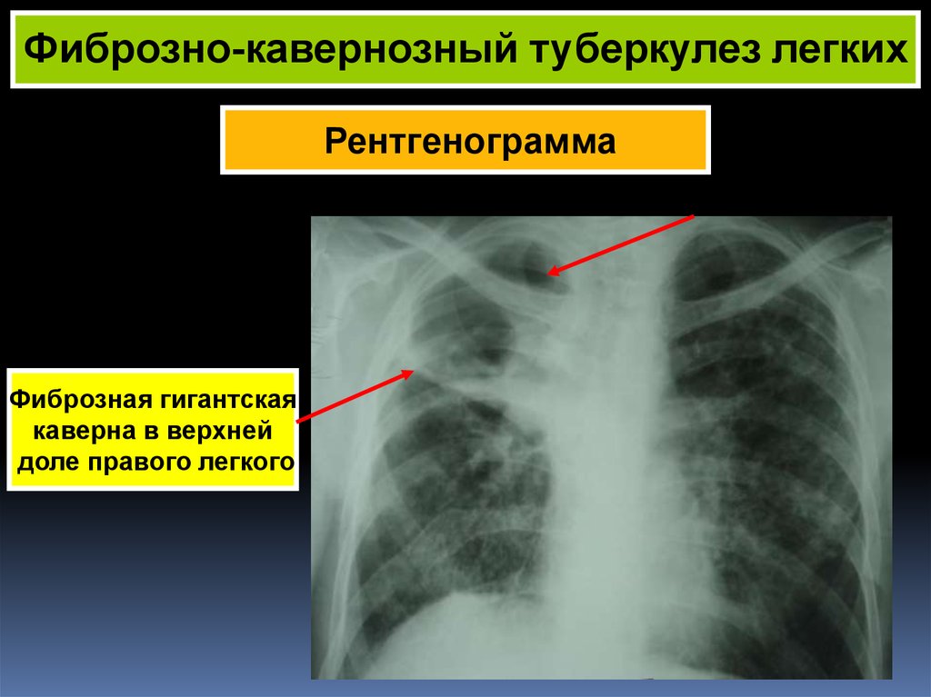 Изменения в верхней доле легкого. Кавернозный туберкулез рентген. Фибринозный кавернозный туберкулез легких. Феброзноковернозный туберкулез. Фиброзо кавернозный туберкулёз.