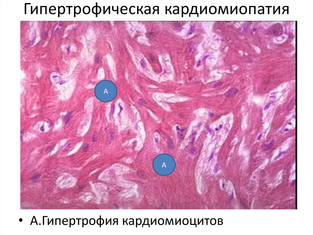 Гипертрофия миокарда рисунок