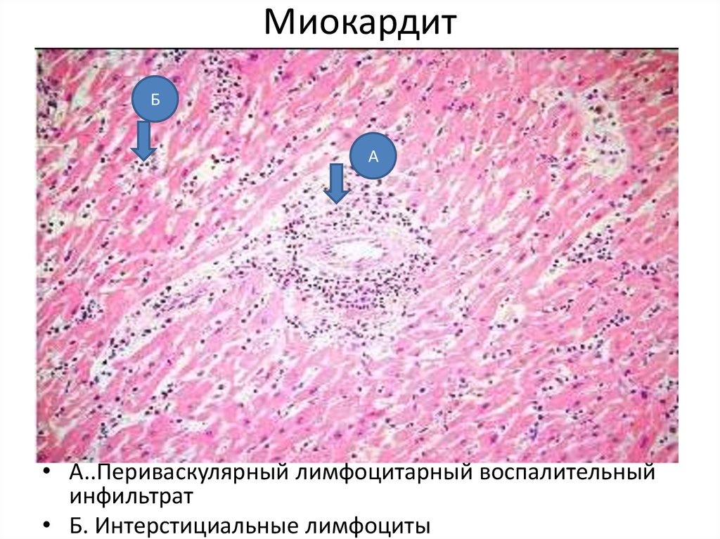 Ревматический миокардит микропрепарат рисунок