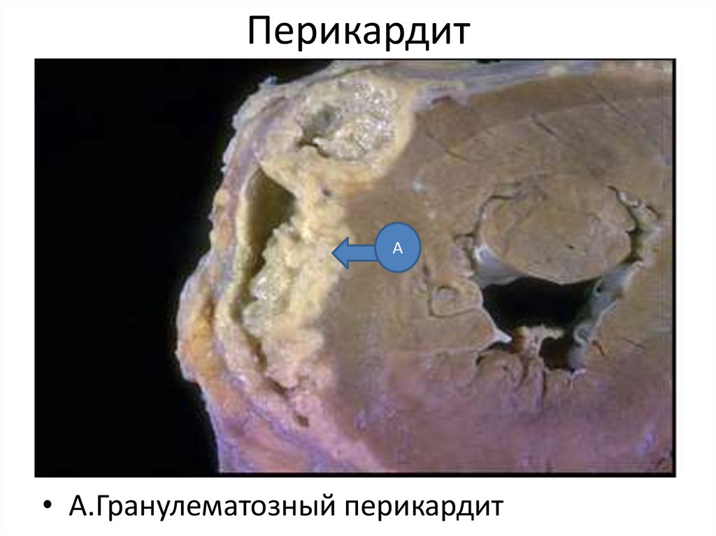 Сердечная недостаточность карта вызова