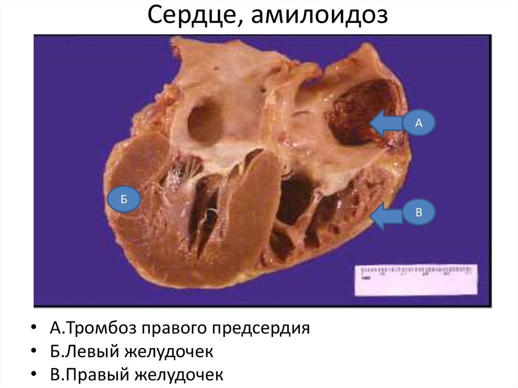 Сердце, амилоидоз