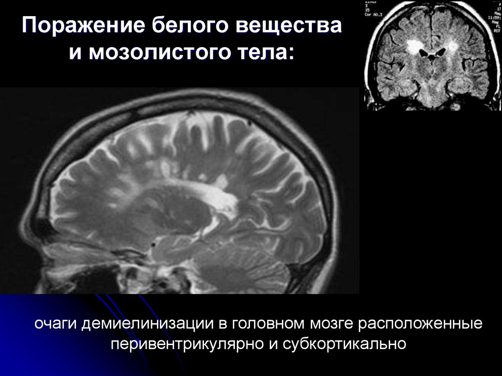Демиелинизация головного. Поражение мозолистого тела при рассеянном склерозе мрт. Очаги демиелинизации на кт. Рассеянный склероз очаги в головном мозге. Очаг демиелинизации в головном на т1.