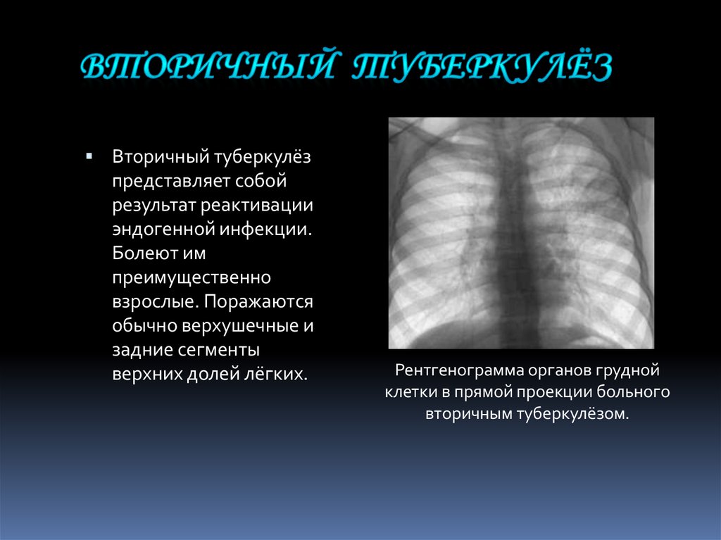 Начальная стадия туберкулеза у взрослых. Формы вторичного туберкулеза легких. Вторичный туберкулез легких.