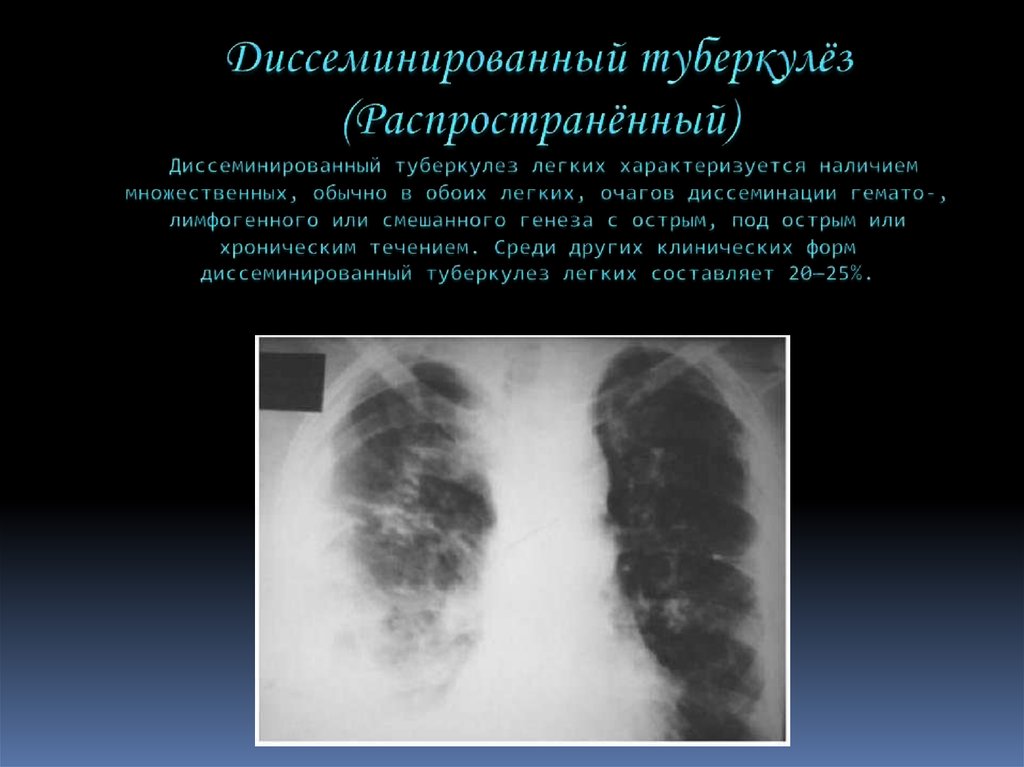 Формы диссеминированного туберкулеза. Хронический диссеминированный туберкулез легких рентген. Хронический диссеминированный туберкулез рентген. Диссеминированный инфильтративный туберкулез. Лимфогенный диссеминированный туберкулез легких это.