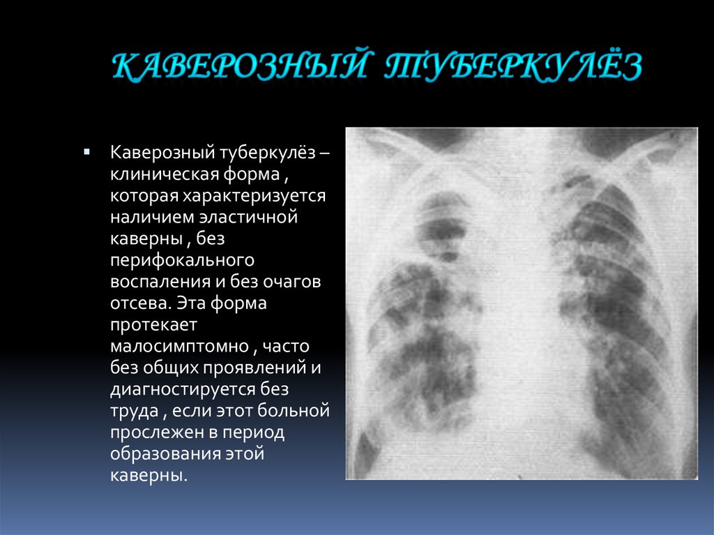 Клинический случай туберкулез. Септический туберкулез. Открытые формы туберкулеза. Тяжелая форма туберкулеза. Легочные формы туберкулеза.