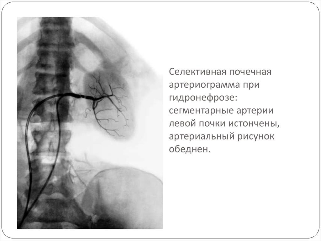 Селективная почечная артериограмма при гидронефрозе: сегментарные артерии левой почки истончены, артериальный рисунок обеднен.