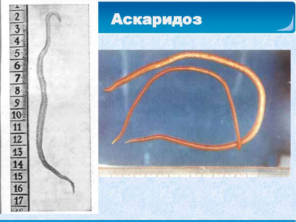 Аскаридоз. Аскариды у детей симптомы. Ранняя фаза аскаридоза. Аскаридоз клинические проявления.