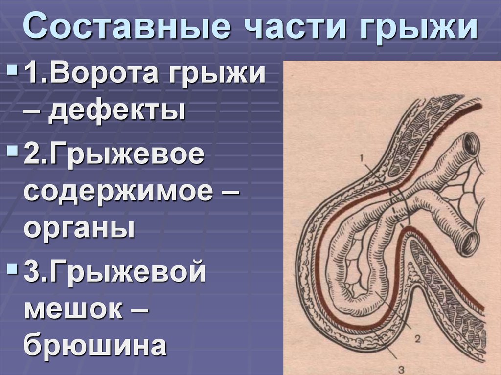 Грыжевые ворота