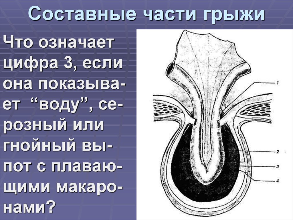 Грыжевой мешок. Составныеияасти грыжи. Составные части грыжи живота. Составляющие части грыжи. Составные части грыжи схема.