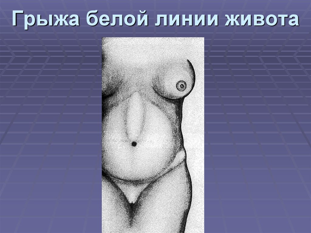 Грыжа белой линии живота