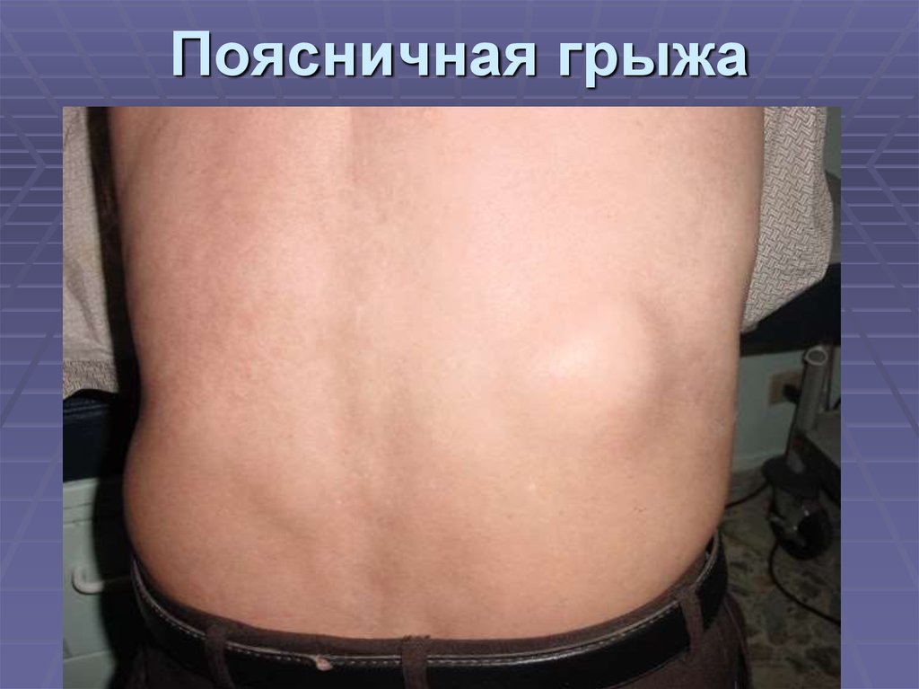 Поясничная грыжа