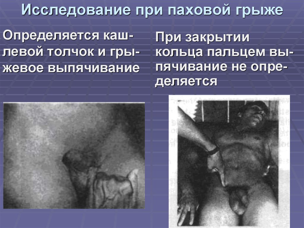 Исследование при паховой грыже