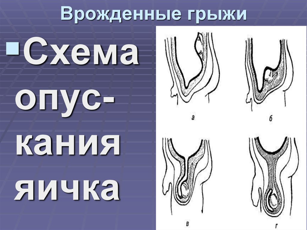 Врожденные паховые грыжи. Врожденная паховая грыжа. Косая приобретенная паховая грыжа. Причины врожденных грыж. Врожденные паховые грыжи. Врожденная паховая грыжа. Косая приобретенная паховая грыжа. Причины врожденных грыж.