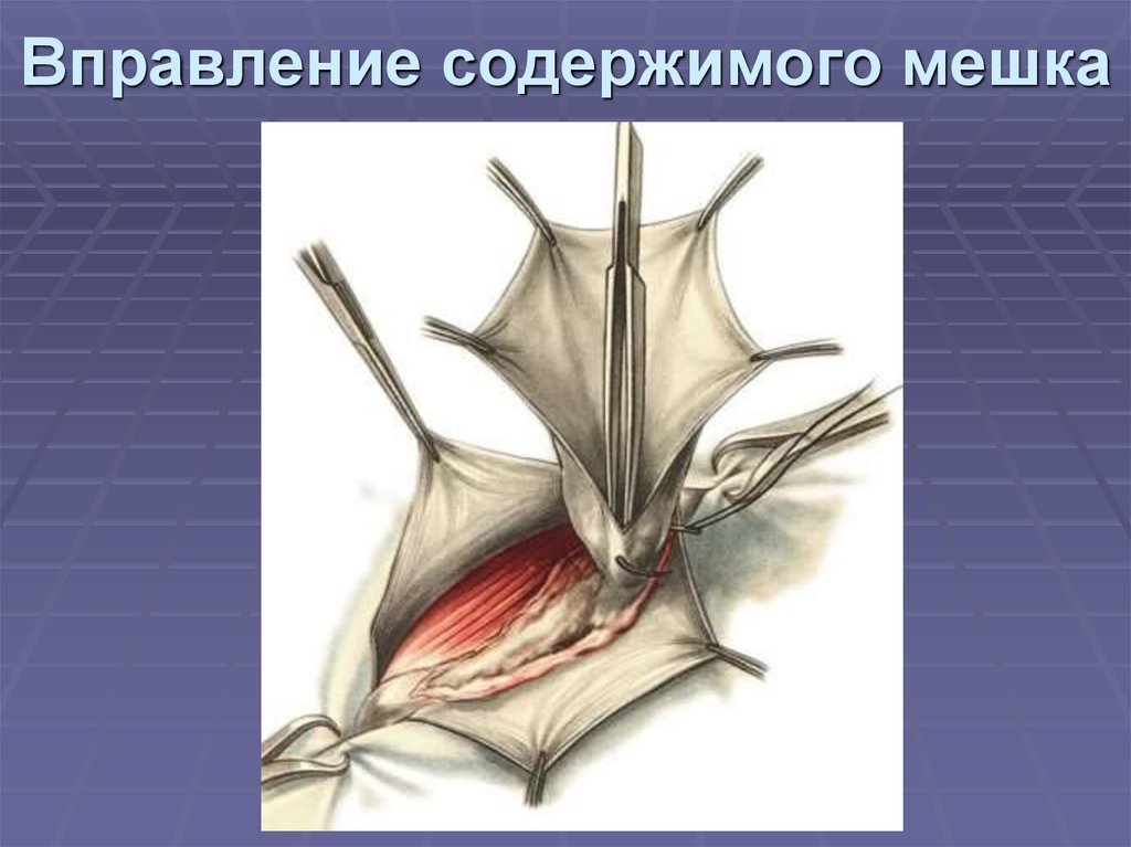 Вправление содержимого мешка