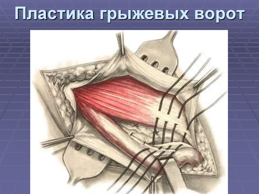 Пластика грыжевых ворот