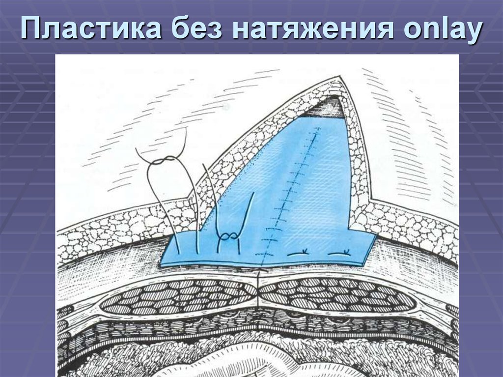 Пластика без натяжения onlay