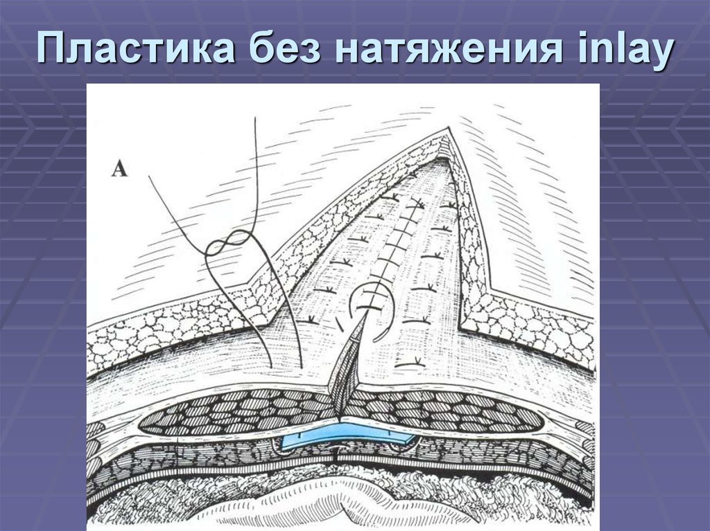 Пластика без натяжения inlay