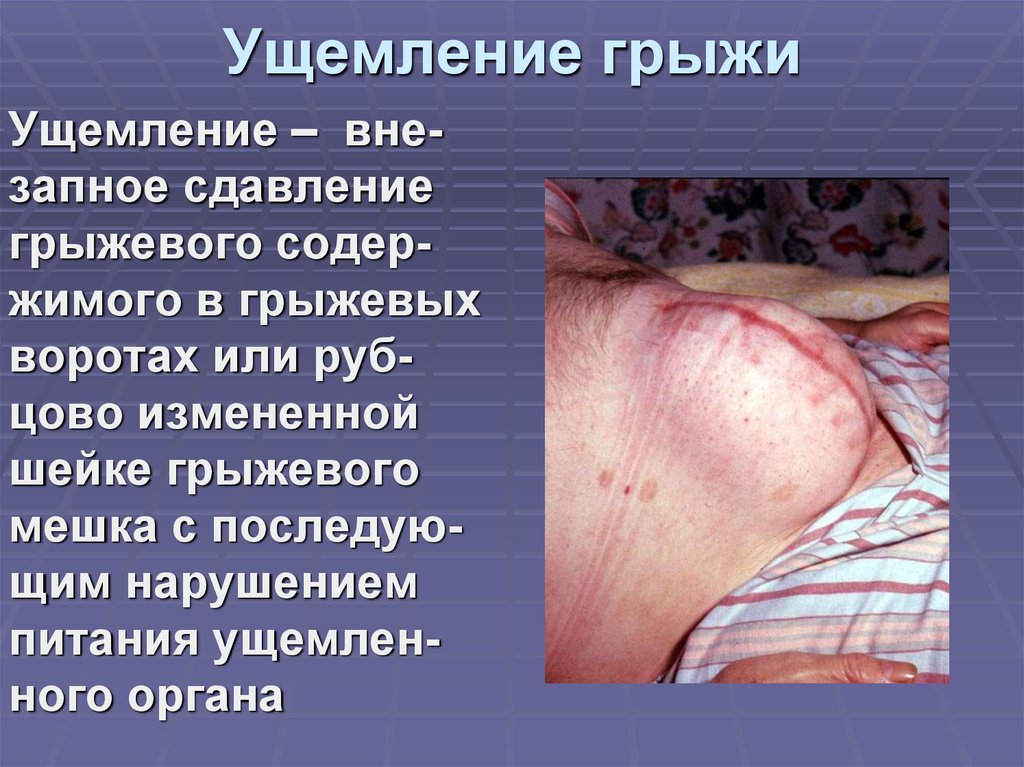 Ущемление грыжи