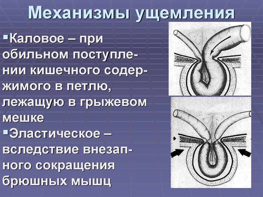 Механизмы ущемления