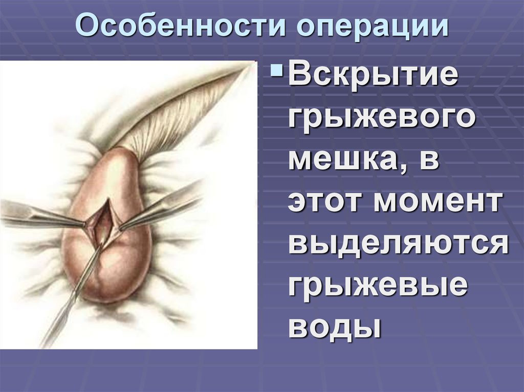 Особенности операции