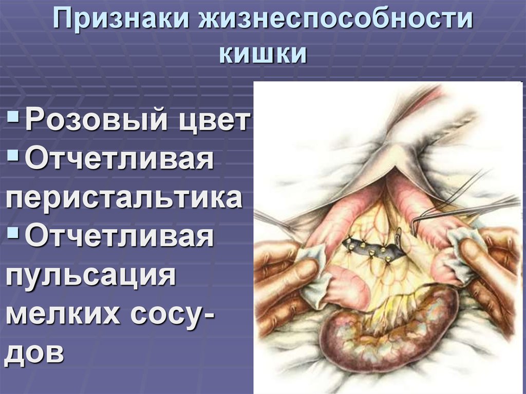 Признаки жизнеспособности кишки