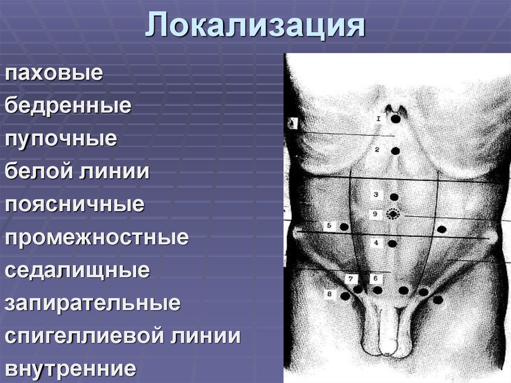 Паховая грыжа. Локализация грыж живота. Локализация это. Паховая грыжа локализация.