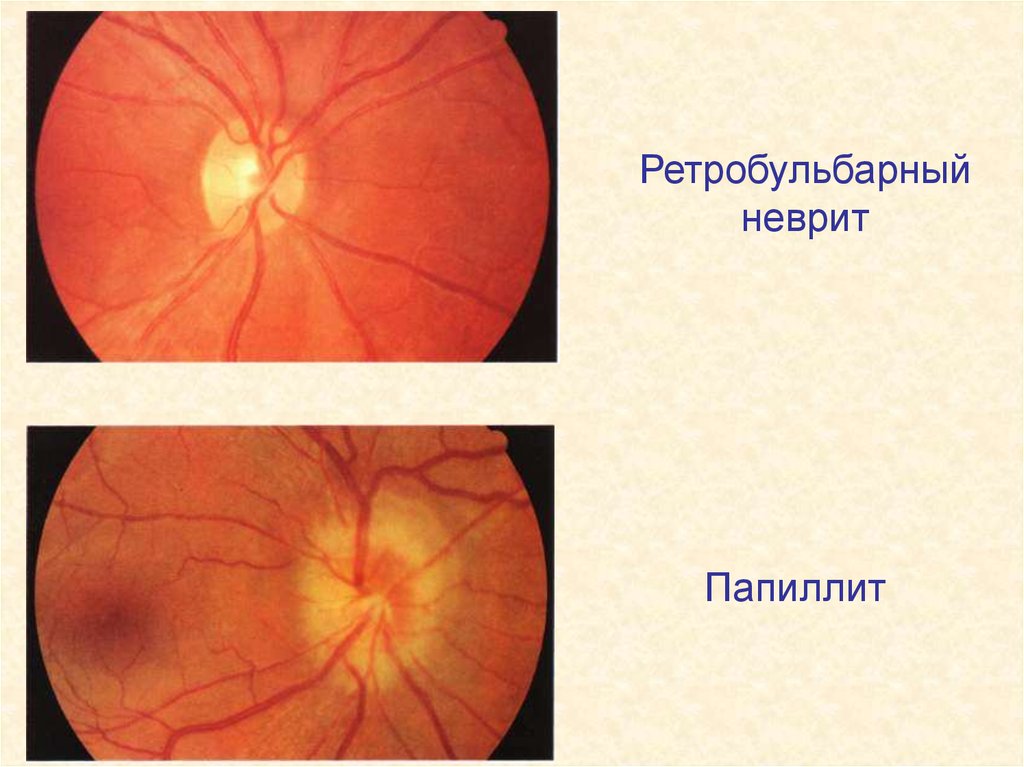 Неврит зрительного нерва презентация