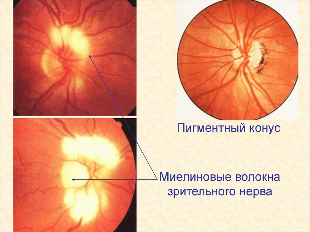 Аномалия развития зрительного нерва. Миелиновые волокна ДЗН. Глазное дно миелиновые волокна. Миелиновые волокна диска зрительного. Миелиновые нервные волокна сетчатки.