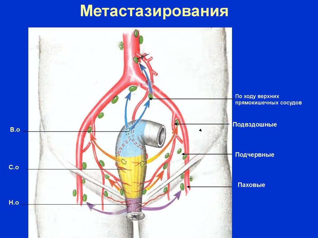 Верхние ходы. Верхние прямокишечные сосуды. Верхние прямокишечные лимфатические узлы. Лимфоузлы по ходу прямокишечных сосудов.