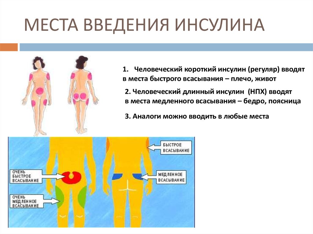 Как вводится инсулин. Сахарный диабет 1 типа техника инъекций инсулина. Места инъекций. Места введения инсулина. Места введения инсулина при сахарном диабете 1. Техника введения длинного инсулина.