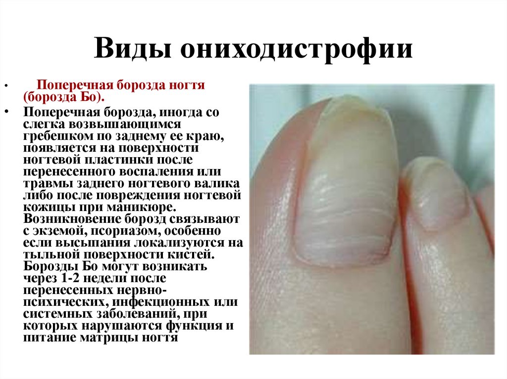 Как распознать по ногтям болезни с фото