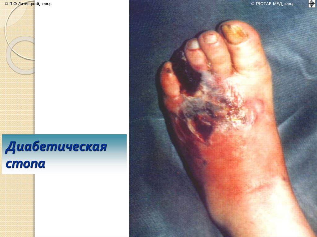 Диабетическая стопа