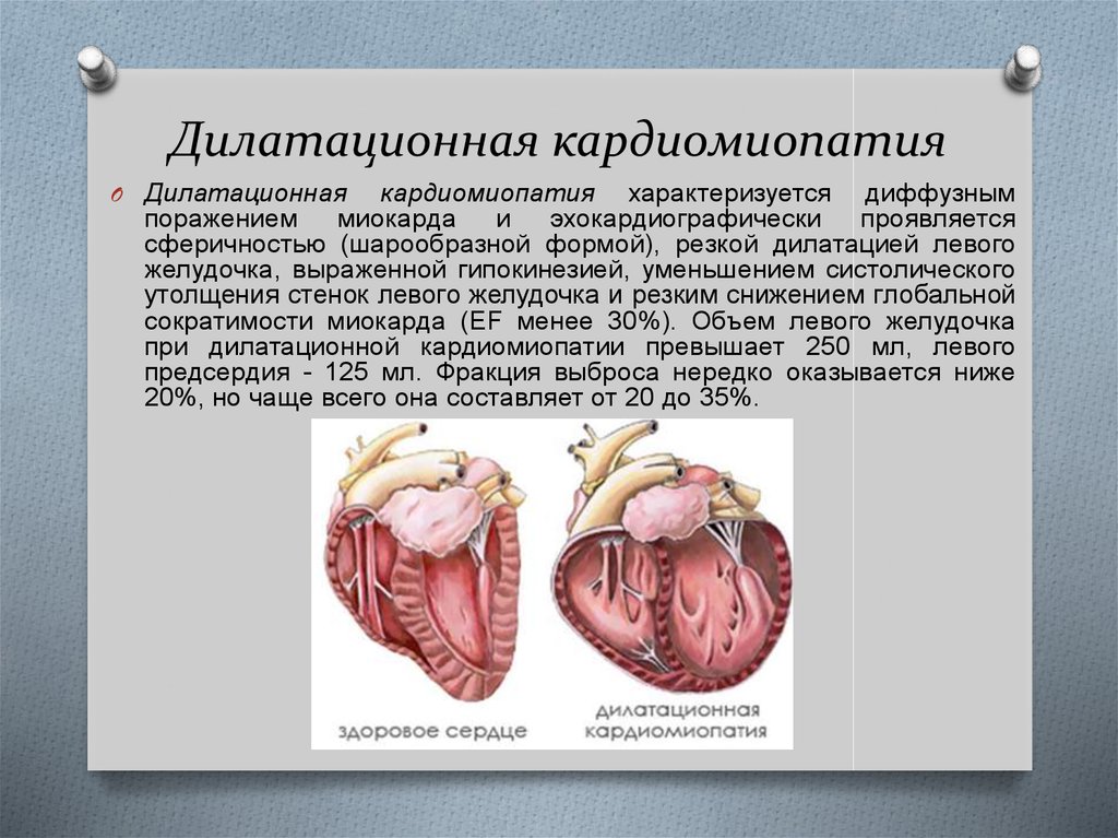 Кардиомиопатии презентация по терапии