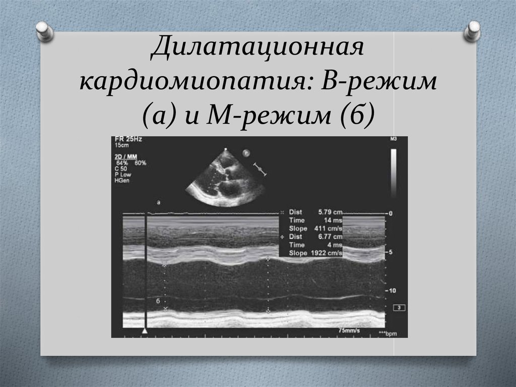 Дилатационная кардиомиопатия мкб