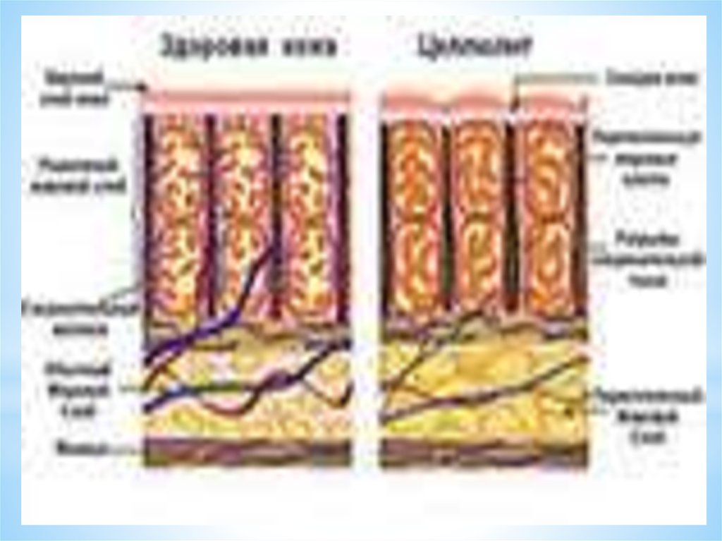 Слои жира. Строение жировой ткани женщины. Расположение жировых клеток у мужчин и женщин. Строение кожи целлюлит. Строение жировой клетки женщины.