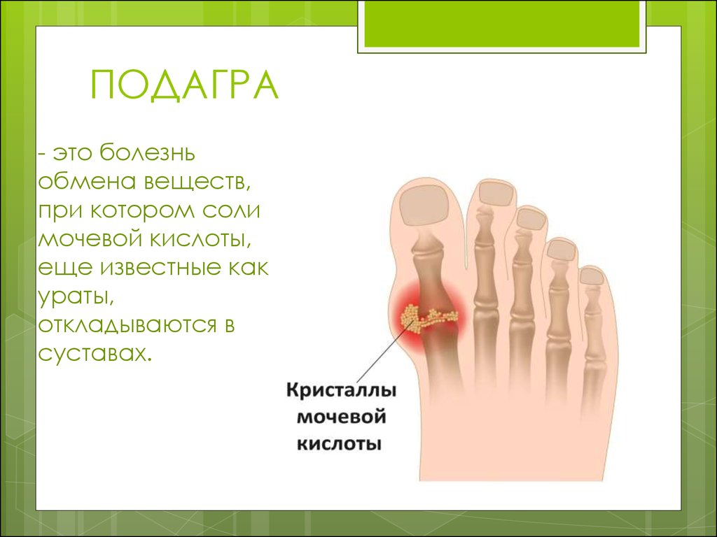 Психосоматика стопы. Подагра психосоматика Синельников. Подагрический артрит психосоматика.