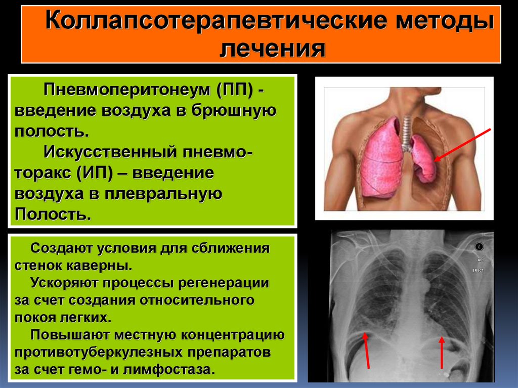 Методы легких. Пневмоперитонеум туберкулез. Искусственный пневмоторакс. Искусственный пневмоторакс при туберкулезе. Искусственный лечебный пневмоторакс.