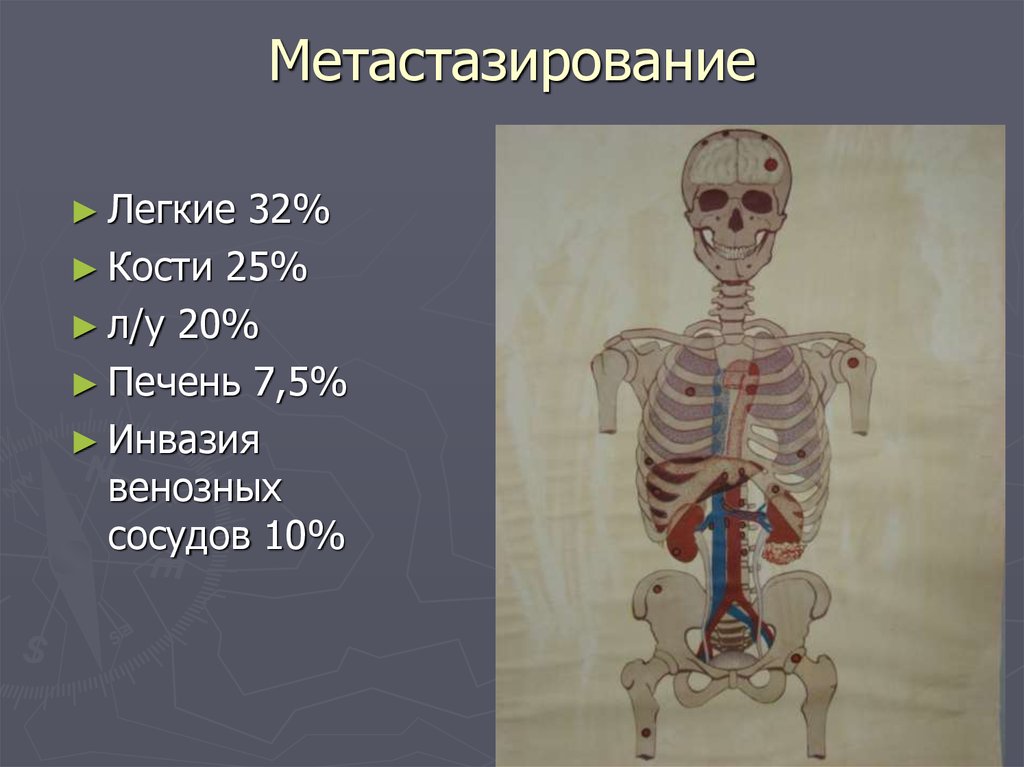 Легкие кости. Метастазирование в легкие и кости. 32 Кости.